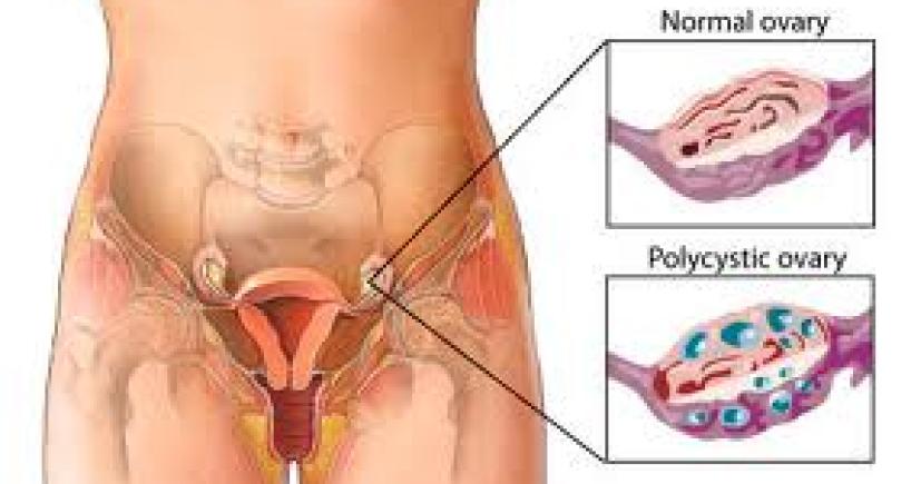 Polycystic Ovarian Syndrome: Symptoms & Treatments